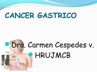 CANCER GASTRICO

Dra. Carmen Cespedes v.
HRUJMCB

 