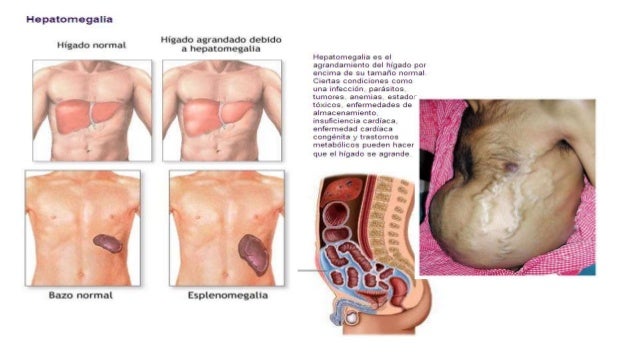 quimioterapia soldier cáncer higado