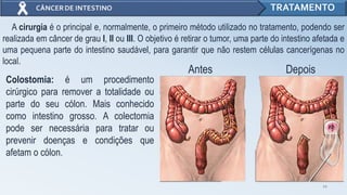 12
TRATAMENTO
A cirurgia é o principal e, normalmente, o primeiro método utilizado no tratamento, podendo ser
realizada em câncer de grau I, II ou III. O objetivo é retirar o tumor, uma parte do intestino afetada e
uma pequena parte do intestino saudável, para garantir que não restem células cancerígenas no
local.
Colostomia: é um procedimento
cirúrgico para remover a totalidade ou
parte do seu cólon. Mais conhecido
como intestino grosso. A colectomia
pode ser necessária para tratar ou
prevenir doenças e condições que
afetam o cólon.
Antes Depois
 