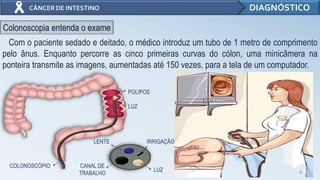 9
DIAGNÓSTICO
Com o paciente sedado e deitado, o médico introduz um tubo de 1 metro de comprimento
pelo ânus. Enquanto percorre as cinco primeiras curvas do cólon, uma minicâmera na
ponteira transmite as imagens, aumentadas até 150 vezes, para a tela de um computador.
Colonoscopia entenda o exame
POLIPOS
LUZ
COLONOSCÓPIO
LENTE IRRIGAÇÃO
CANAL DE
TRABALHO
LUZ
 