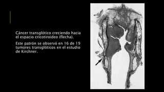 Cáncer transglótico creciendo hacia
el espacio cricotiroideo (flecha).
Este patrón se observó en 16 de 19
tumores transglóticos en el estudio
de Kirchner.
 