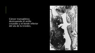 Cáncer transglótico
destruyendo el anillo
cricoides y el borde inferior
del ala de la tiroides.
 
