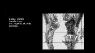 Cabcer glótico
invadiendo y
destruyendo el anillo
cricoides
 