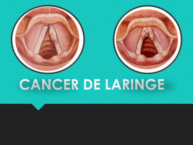 Cáncer De Laringe: Causas, Síntomas Y Tratamiento – VSALBC