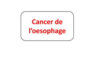 Cancer de
l’oesophage
 