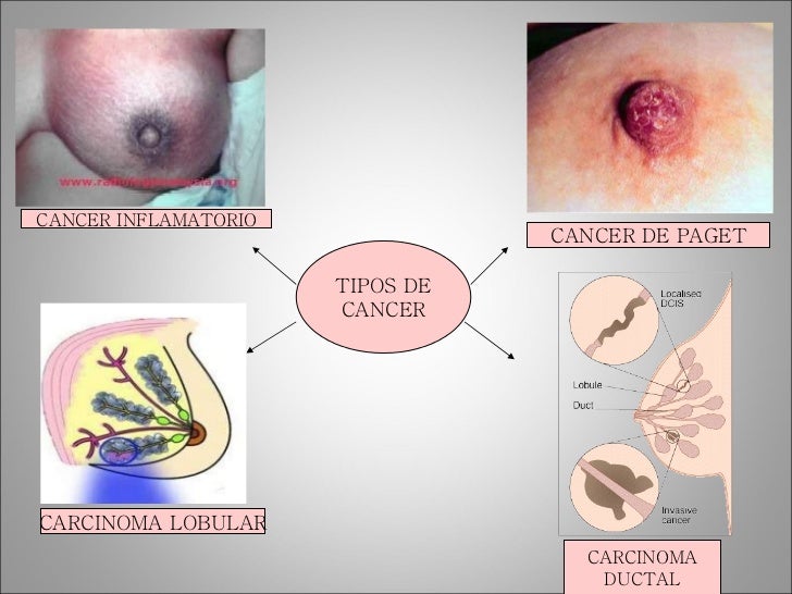 Cancer De Mama