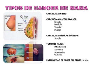 CARCINOMA IN SITU

CARCINOMA DUCTAL INVASOR:
      Simple
      Medular
      Tubular
      Papilar

CARCINOMA LOBULAR INVASOR:
      Simple

TUMORES RAROS:
     Inflamatorio
     Sarcoma
     Adenoideo
     Quístico

ENFERMEDAD DE PAGET DEL PEZÓN: In situ
 