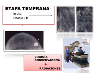 ETAPA TEMPRANA:
  In situ
  Estadio I, II




                  CIRUGÍA
                  CONSERVADORA
                      +
                    RADIACIONES
 