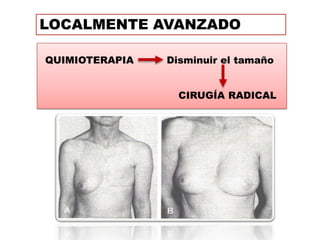 LOCALMENTE AVANZADO

QUIMIOTERAPIA   Disminuir el tamaño


                  CIRUGÍA RADICAL
 