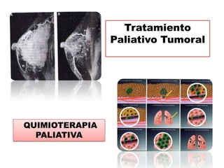 Tratamiento
                Paliativo Tumoral




QUIMIOTERAPIA
  PALIATIVA
 