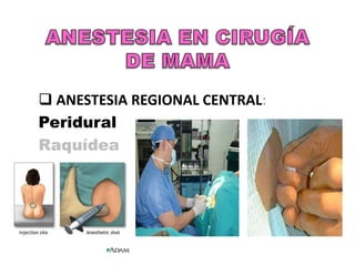  ANESTESIA REGIONAL CENTRAL:
Peridural
Raquídea
 