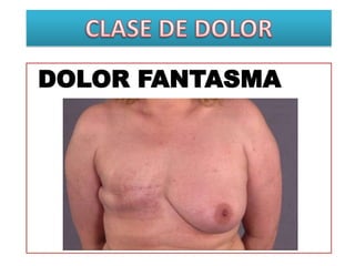 DOLOR FANTASMA
 