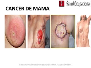 CANCER DE MAMA




    CACECSISO SU PRIMERA OPCION EN SEGURIDAD INDUSTRIAL Y SALUD OCUPACIONAL
 