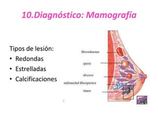10.Diagnóstico: Mamografía


Tipos de lesión:
• Redondas
• Estrelladas
• Calcificaciones
 