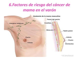 6.Factores de riesgo del cáncer de
        mama en el varón
 