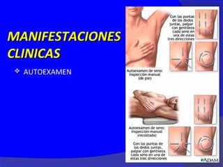 MANIFESTACIONES
CLINICAS
   AUTOEXAMEN
 