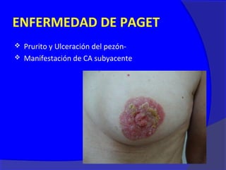 ENFERMEDAD DE PAGET
 Prurito y Ulceración del pezón-
 Manifestación de CA subyacente
 