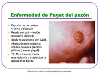 Enfermedad de Paget del pezón
 Erupción eccematosa
crónica del pezón
 Puede ser sutil – lesión
exudativa ulcerada.
 Suele relacionarse con CDIS
 Alteración patognómica:
células acuosas grandes
pálidas (células paget)
 Tto Qx= tumorectomía,
mastectomía o mastectomía
radical modificada.
Schwartz, principios de cirugia /consideraciones especificas.
 