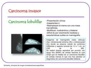 Carcinoma invasor
Carcinoma lobulillar -Presentación clínica
-Inaparentes ó
-Reemplazan la mama con una masa
mal definida.
-Multifocal, multicéntrico y bilateral.
-Difícil dx por crecimiento insidioso y
características sutiles en mamografía.
Imágenes de mamografía vistas oblícuas
(3a), cráneocaudal extrema (3b) y cráneocaudal
(3c) donde se observa nódulo de contornos
infiltrantes y aspecto tumoral de 1,3 x 1 cm. en
CSE de la MD.
Se realizó biopsia aspirativa por punción con
aguja fina (BAAF) de ambas lesiones la cual
arrojó que se trataba de un carcinoma lobulillar
en ambas mamas lo que nos hizo plantear el
diagnóstico de carcinoma lobulillar bilateral.
Schwartz, principios de cirugia /consideraciones especificas.
 