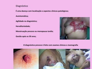 Diagnóstico
É uma doença com localização e aspectos clínicos-patológicos;
O diagnóstico precoce é feito com exames clínicos e mamografia
Assintomática;
Agilidade no diagnóstico;
Hereditariedade;
Menstruação precoce ou menopausa tardia;
Gestão após os 30 anos;
 