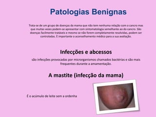 Trata-se de um grupo de doenças da mama que não tem nenhuma relação com o cancro mas
que muitas vezes podem-se apresentar com sintomatologia semelhante ao do cancro. São
doenças facilmente tratáveis e mesmo se não forem completamente resolvidas, podem ser
controladas. È importante o aconselhamento médico para a sua avaliação.
Patologias Benignas
Infecções e abcessos
são infecções provocadas por microrganismos chamados bactérias e são mais
frequentes durante a amamentação.
A mastite (infecção da mama)
É o acúmulo de leite sem a ordenha
 