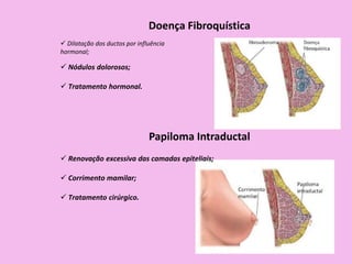 Doença Fibroquística
 Nódulos dolorosos;
 Tratamento hormonal.
 Dilatação dos ductos por influência
hormonal;
Papiloma Intraductal
 Corrimento mamilar;
 Tratamento cirúrgico.
 Renovação excessiva das camadas epiteliais;
 