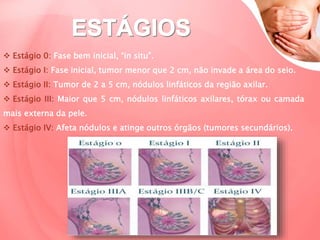  Estágio 0: Fase bem inicial, “in situ”.
 Estágio I: Fase inicial, tumor menor que 2 cm, não invade a área do seio.
 Estágio II: Tumor de 2 a 5 cm, nódulos linfáticos da região axilar.
 Estágio III: Maior que 5 cm, nódulos linfáticos axilares, tórax ou camada
mais externa da pele.
 Estágio IV: Afeta nódulos e atinge outros órgãos (tumores secundários).
 
