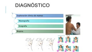 DIAGNÓSTICO
Exploración clínica de mamas
Mastografía
Ecografía
Biopsia
 