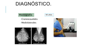 DIAGNÓSTICO.
-Craneocaudales
-Mediolaterales
Mastografía 40 años
 