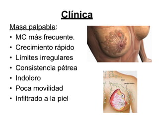 Clínica
Masa palpable:
• MC más frecuente.
• Crecimiento rápido
• Límites irregulares
• Consistencia pétrea
• Indoloro
• Poca movilidad
• Infiltrado a la piel
 