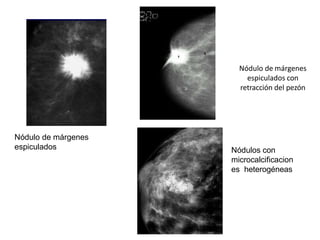 Nódulo de márgenes
espiculados Nódulos con
microcalcificacion
es heterogéneas
Nódulo de márgenes
espiculados con
retracción del pezón
 