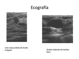Ecografía
Una masa sólida de borde
irregular Quiste redondo de bordes
lisos
 