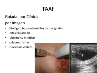 PAAF
Guiada: por Clínica
por Imagen
• Citológico busca elementos de malignidad:
• -alta celularidad
• -alto índice mitótico
• - pleomorfismo
• -nucléolos visibles
 