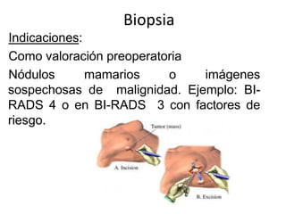 Biopsia
Indicaciones:
Como valoración preoperatoria
Nódulos mamarios o imágenes
sospechosas de malignidad. Ejemplo: BI-
RADS 4 o en BI-RADS 3 con factores de
riesgo.
 