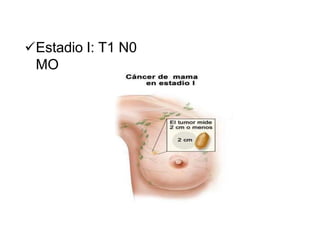 Estadio I: T1 N0
MO
 
