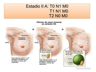 Estadio II A: T0 N1 M0
T1 N1 M0
T2 N0 M0
 