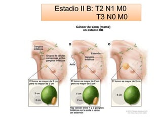 Estadio II B: T2 N1 M0
T3 N0 M0
 