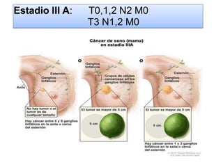 Estadio III A: T0,1,2 N2 M0
T3 N1,2 M0
 