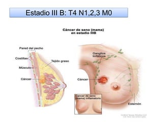 Estadio III B: T4 N1,2,3 M0
 