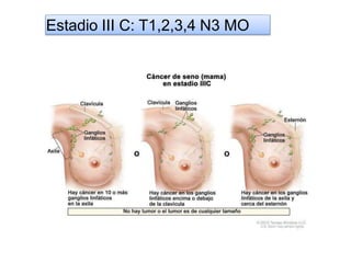 Estadio III C: T1,2,3,4 N3 MO
 