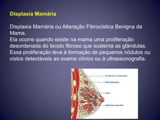 Displasia Mamária

Displasia Mamária ou Alteração Fibrocística Benigna da
Mama.
Ela ocorre quando existe na mama uma proliferação
desordenada do tecido fibroso que sustenta as glândulas.
Essa proliferação leva à formação de pequenos nódulos ou
cistos detectáveis ao exame clínico ou à ultrassonografia.
 