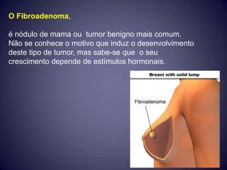 O Fibroadenoma,

é nódulo de mama ou tumor benigno mais comum.
Não se conhece o motivo que induz o desenvolvimento
deste tipo de tumor, mas sabe-se que o seu
crescimento depende de estímulos hormonais.
 