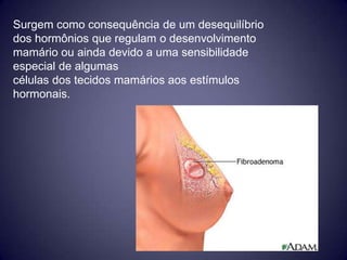 Surgem como consequência de um desequilíbrio
dos hormônios que regulam o desenvolvimento
mamário ou ainda devido a uma sensibilidade
especial de algumas
células dos tecidos mamários aos estímulos
hormonais.
 