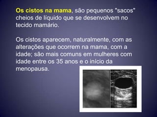 Os cistos na mama, são pequenos "sacos"
cheios de líquido que se desenvolvem no
tecido mamário.

Os cistos aparecem, naturalmente, com as
alterações que ocorrem na mama, com a
idade; são mais comuns em mulheres com
idade entre os 35 anos e o início da
menopausa.
 