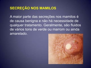 SECREÇÃO NOS MAMILOS

A maior parte das secreções nos mamilos é
de causa benigna e não há necessidade de
qualquer tratamento. Geralmente, são fluidos
de vários tons de verde ou marrom ou ainda
amarelado.
 