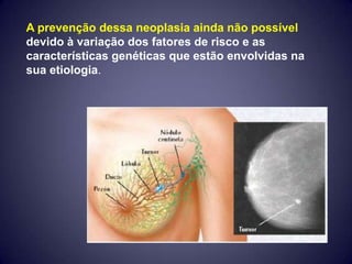 A prevenção dessa neoplasia ainda não possível
devido à variação dos fatores de risco e as
características genéticas que estão envolvidas na
sua etiologia.
 
