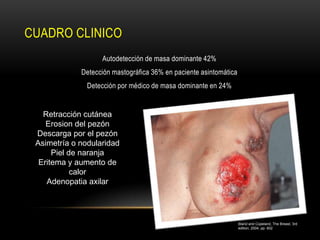 CUADRO CLINICO
                   Autodetección de masa dominante 42%
             Detección mastográfica 36% en paciente asintomática
               Detección por médico de masa dominante en 24%


   Retracción cutánea
    Erosion del pezón
 Descarga por el pezón
 Asimetría o nodularidad
      Piel de naranja
  Eritema y aumento de
            calor
    Adenopatia axilar




                                                                   Bland and Copeland, The Breast, 3rd
                                                                   edition, 2004, pp. 602
 