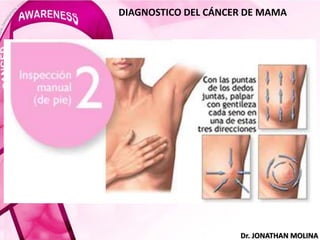 DIAGNOSTICO DEL CÁNCER DE MAMA
Dr. JONATHAN MOLINA
 