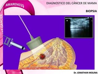 DIAGNOSTICO DEL CÁNCER DE MAMA
BIOPSIA
Dr. JONATHAN MOLINA
 