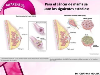 Para el cáncer de mama se
usan los siguientes estadios:
Dr. JONATHAN MOLINA
 